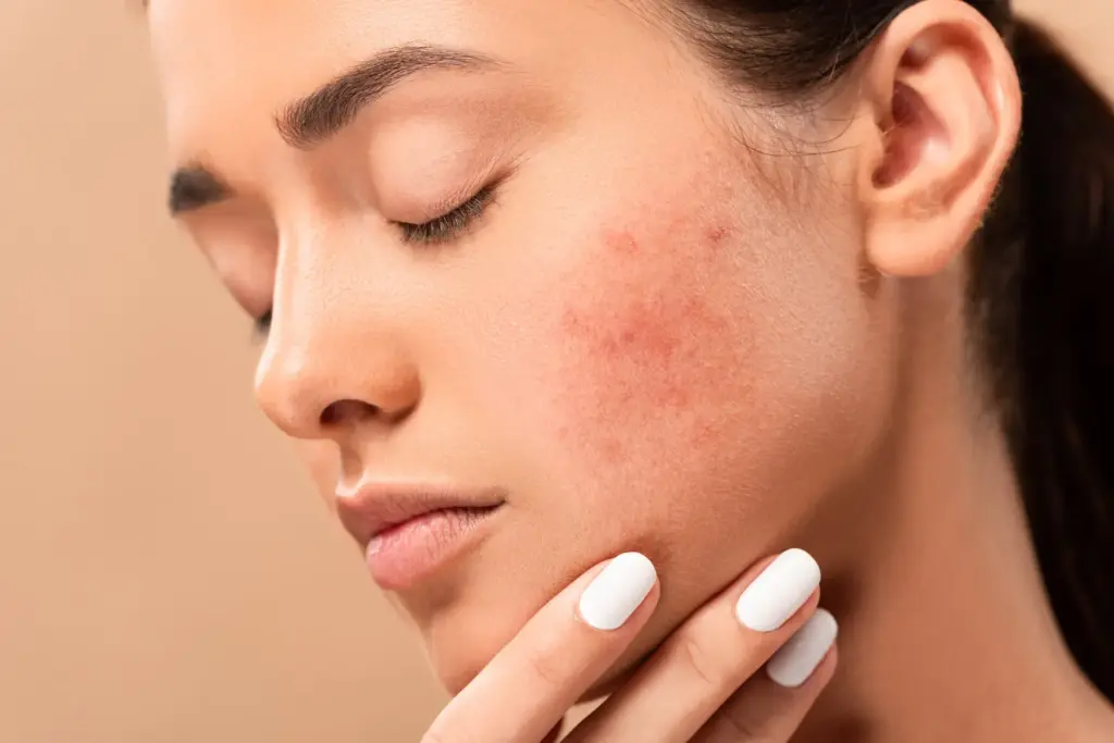 Acne Treatments in Maple Grove | BBL, Peel & Microneedling in Maple Grove, MN